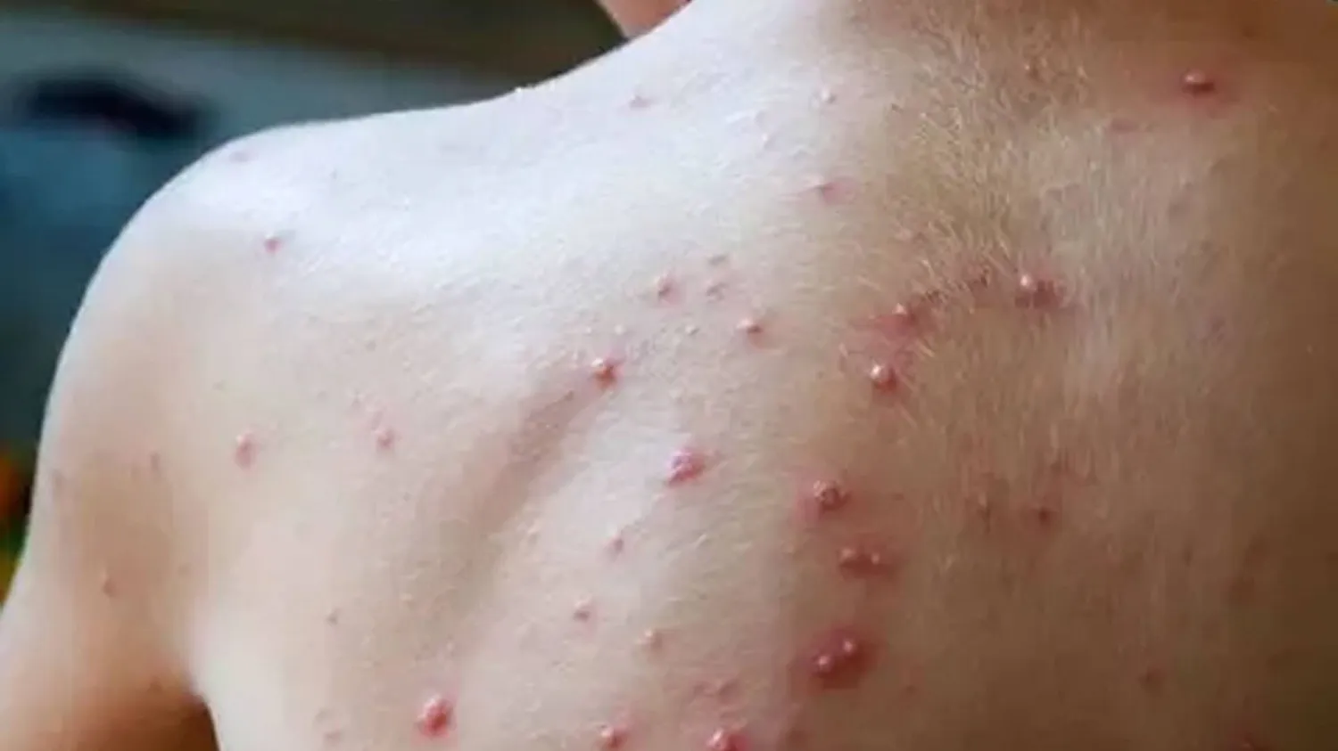 وزارة الصحة بنيويورك تعلن ظهور جدري القرود - أرشيفية