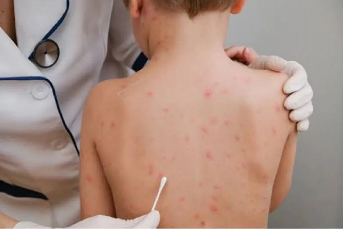 مرض جدري القرود - أرشيفية (1)