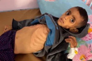 أطفال غزة يموتون جوعًا على يد الاحتلال الإسرائيلي